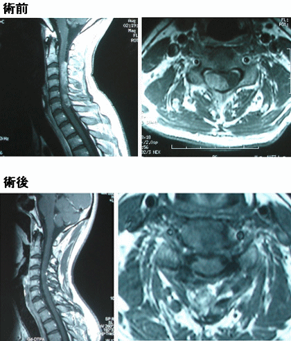 脊髄腫瘍イメージ写真