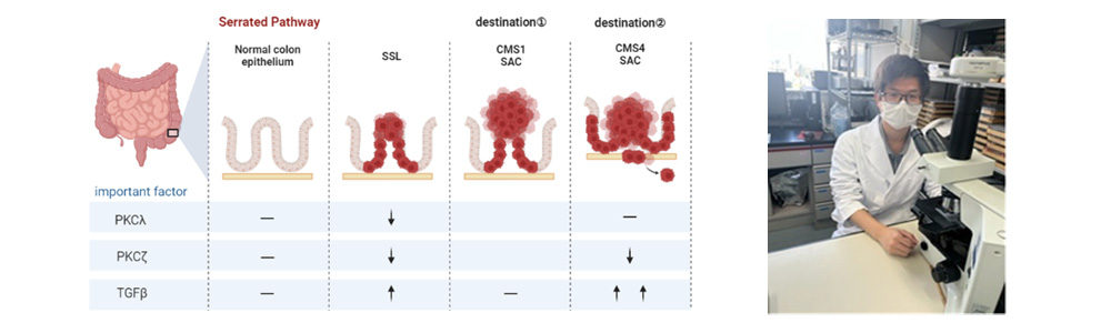 間質反応強いCMS4型大腸癌およびスキルス胃癌の分子生物学的研究
