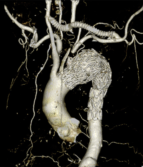 右総頸動脈-左総頸動脈バイパス, 左総頸動脈-左鎖骨下動脈バイパス術後にステント挿入