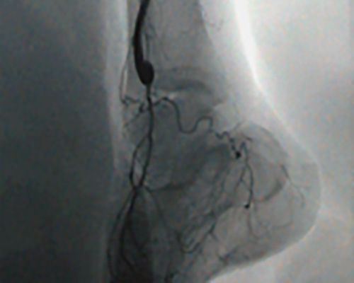 膝窩動脈—前脛骨動脈バイパス術