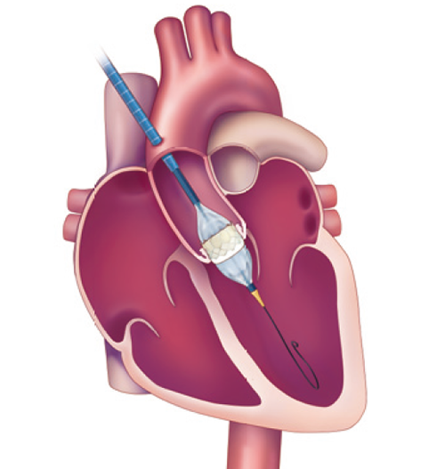 経カテーテル的大動脈弁置換術（ＴＡＶＩ）