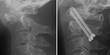 環軸椎亜脱臼に対する環軸椎固定術：術前後のレントゲン側面