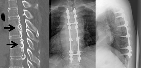 左：術前CT（矢印：後縦靭帯骨化）、中：術後レントゲン正面、右：術後レントゲン側面