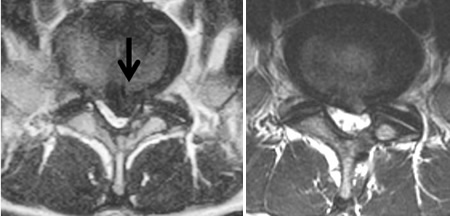 腰椎MRI　腰椎椎間板ヘルニア　左　術前（矢印がヘルニア）　右　術後