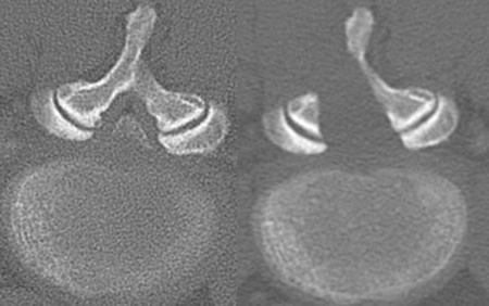 腰部脊柱管狭窄に対する内視鏡手術：術前後のレントゲン