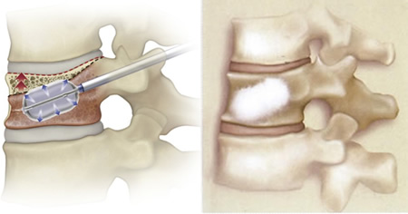 左図　経皮的にカテーテルを挿入し先端のバルーンを拡張させて椎体の復元をはかります。右図　バルーンで拡張した椎体内にセメントを注入します