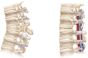 骨折椎体の後方要素を短縮し後弯変形を矯正