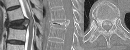術前MRI（第8胸椎椎体骨折）および術前CT