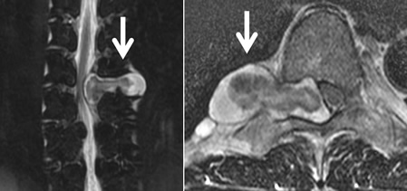 硬膜外腫瘍のMRI（矢印：腫瘍）