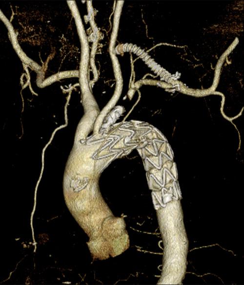 左総頸動脈-左鎖骨下動脈バイパス術後にステント挿入