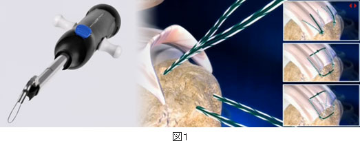 骨孔式鏡視下腱板修復術